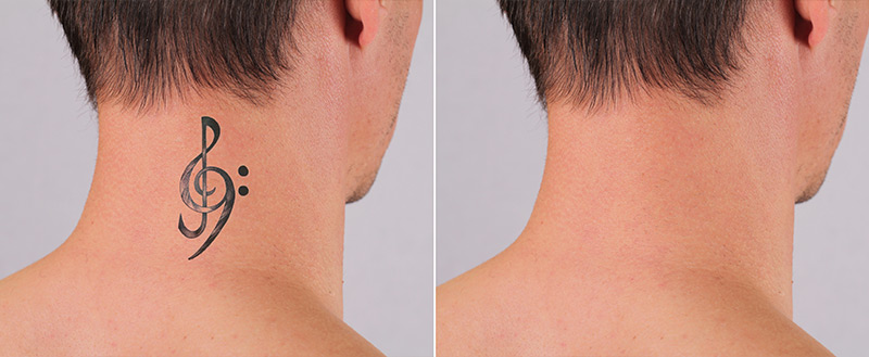 before and after tattoo removal in chennai