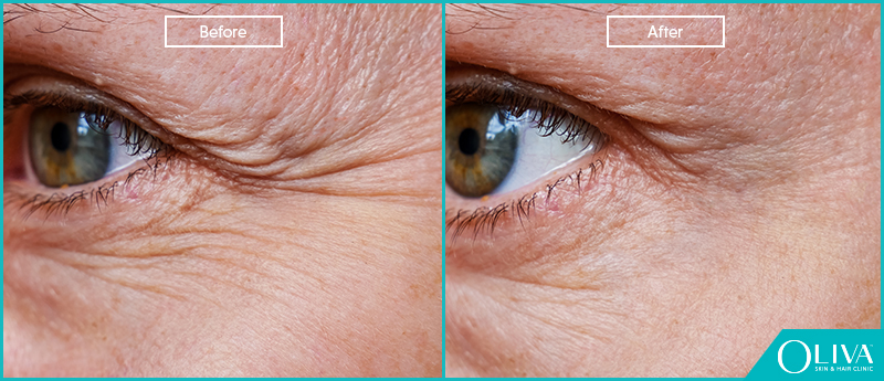 crows feet on face before and after results