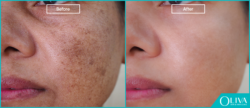 Dead Skin On Face Before And After Results