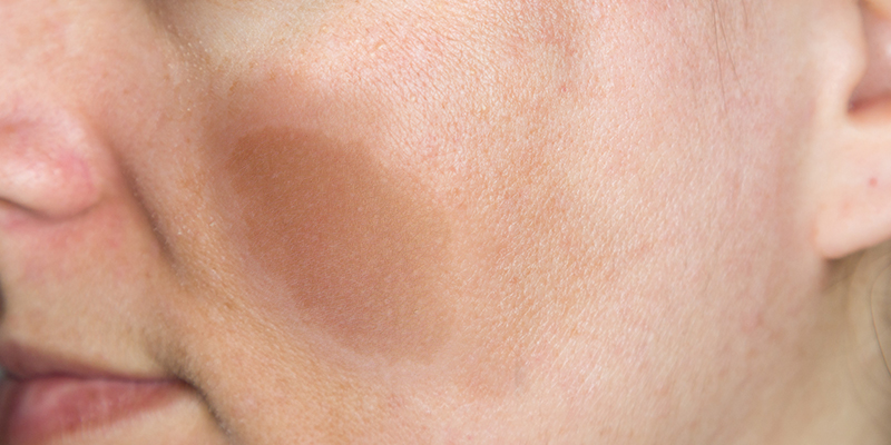 Café Au Lait Spots Pictures