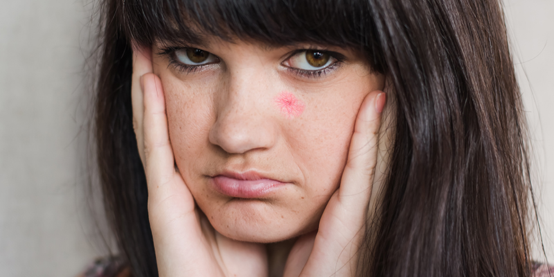 Spider Angioma(Spider Nevus)