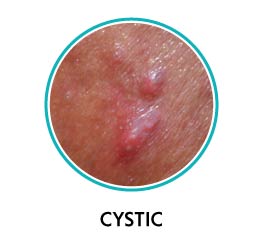 cystic acne vulgaris cystic acne vulgaris