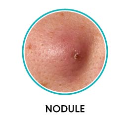 nodular acne vulgaris nodular acne vulgaris