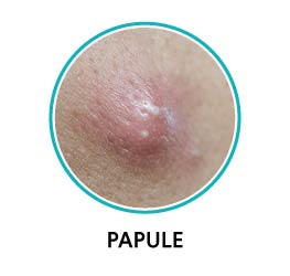 papules acne papules acne