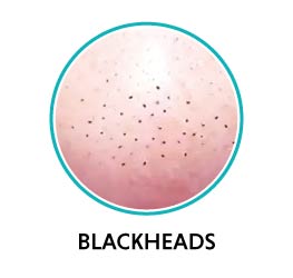 blackheads on nose blackheads on nose