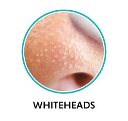 whitehead acne on nose whitehead acne on nose