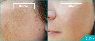 laser resurfacing before and after