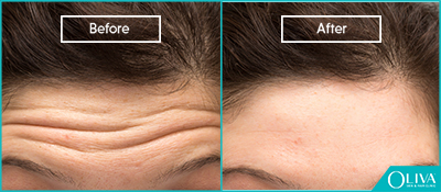 laser resurfacing before and after