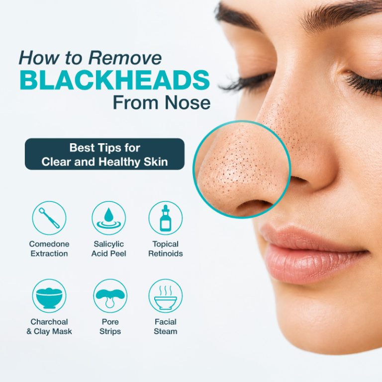 How To Remove Blackheads On Nose