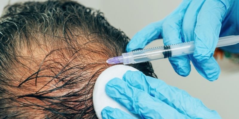prp hair loss treatment in chennai