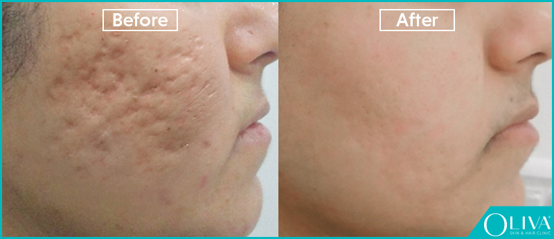 rolling scars before and after