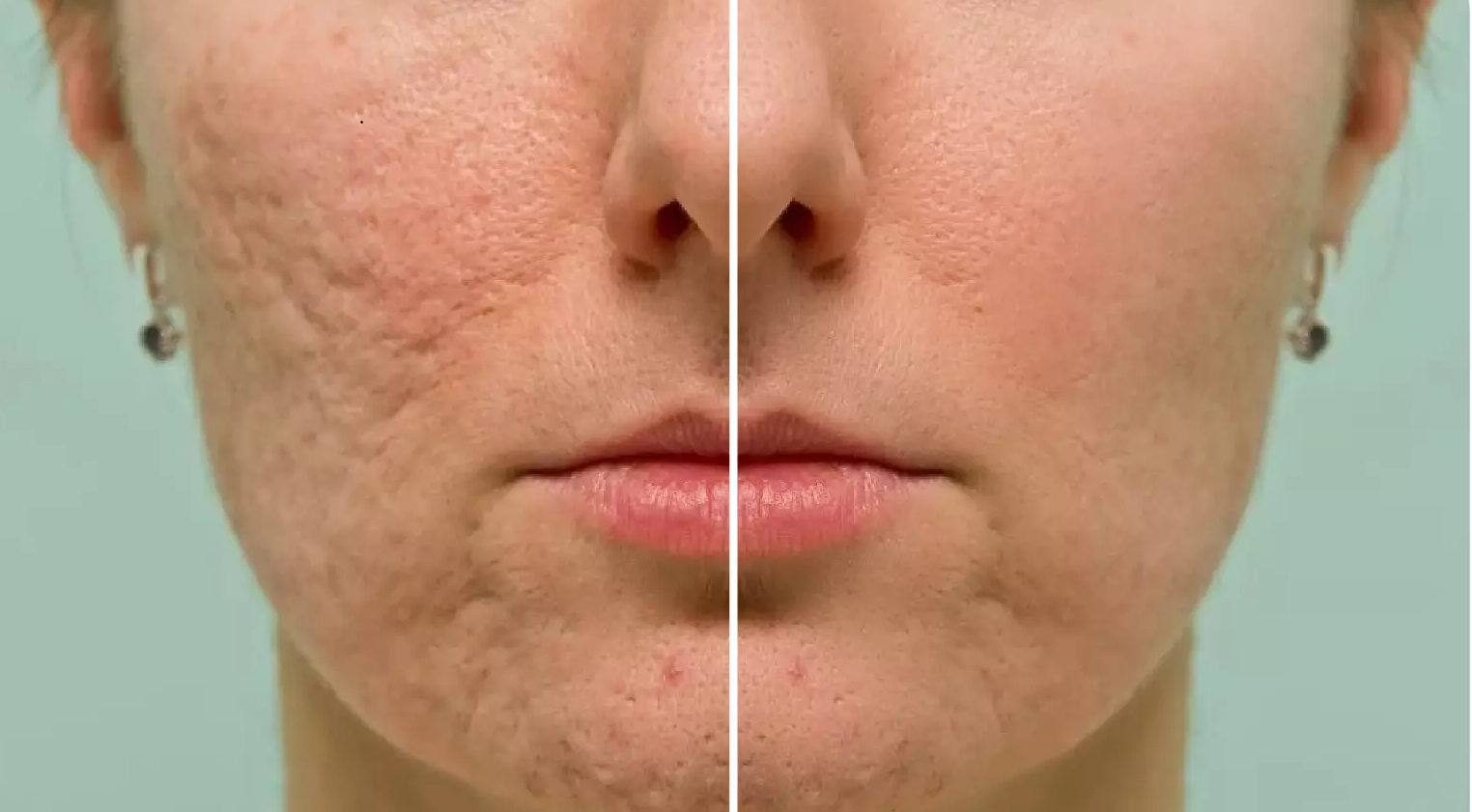 Subcision-Treatment-For-Acne-Scars