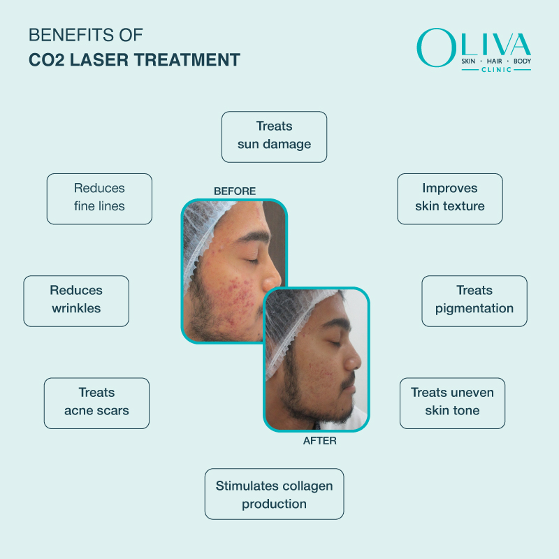 CO2 Laser Treatmetn Benefits