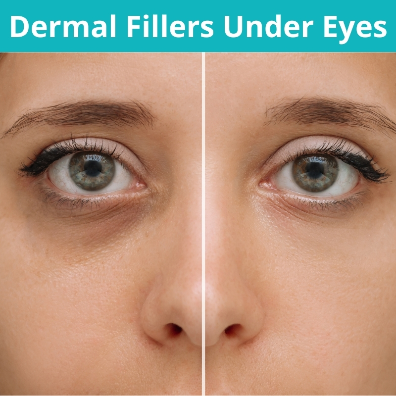 Dermal Fillers Under Eyes