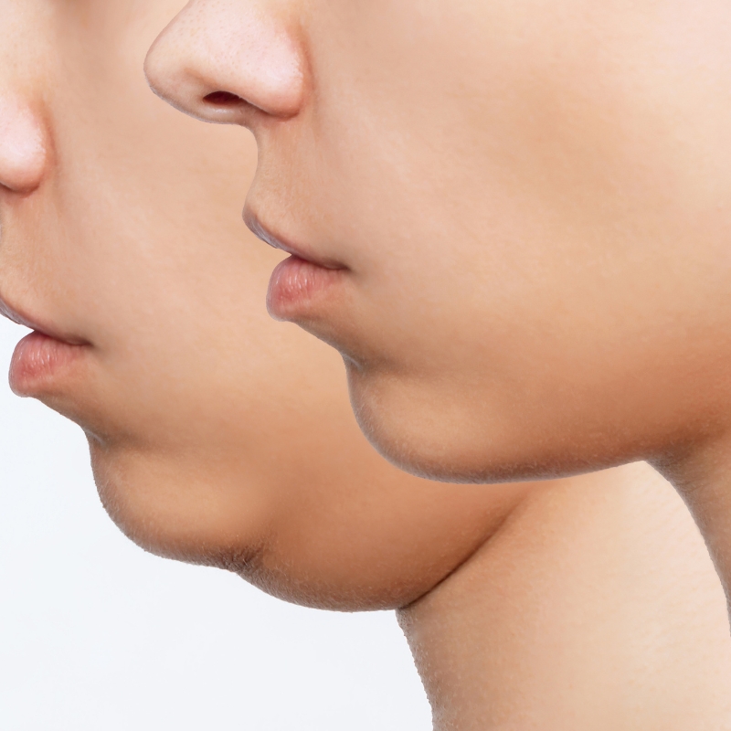 double chin exercise