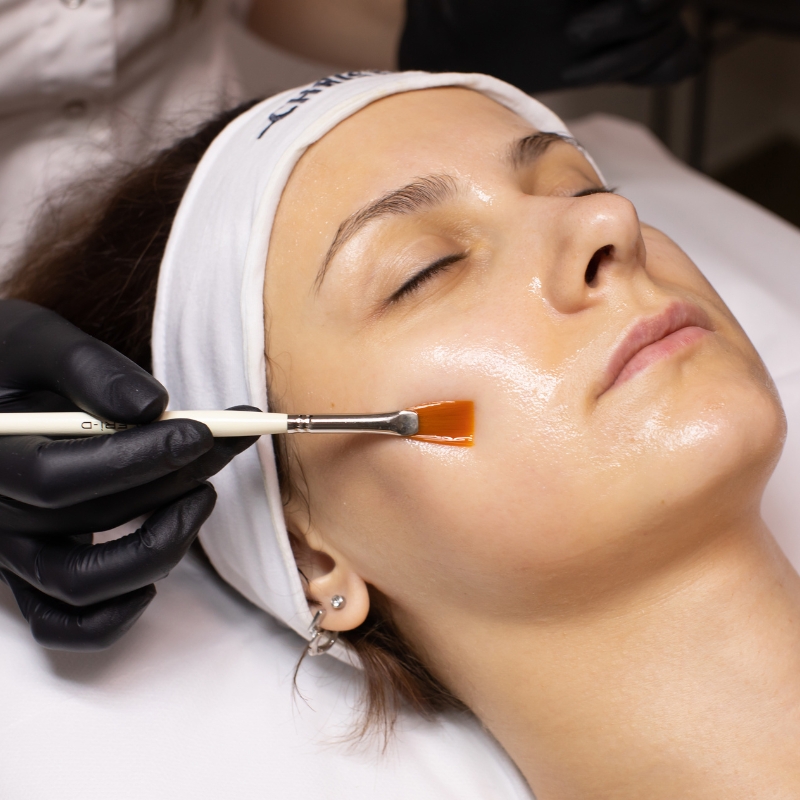 chemical peels in hyderabad