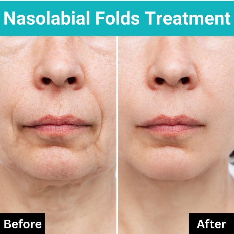 nasolabial folds treatment