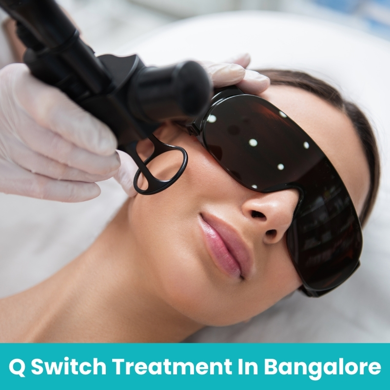 q switch laser treatment in bangalore