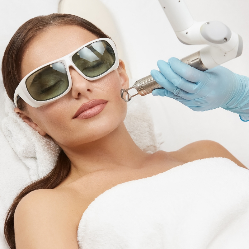 q switch laser treatment in hyderabad