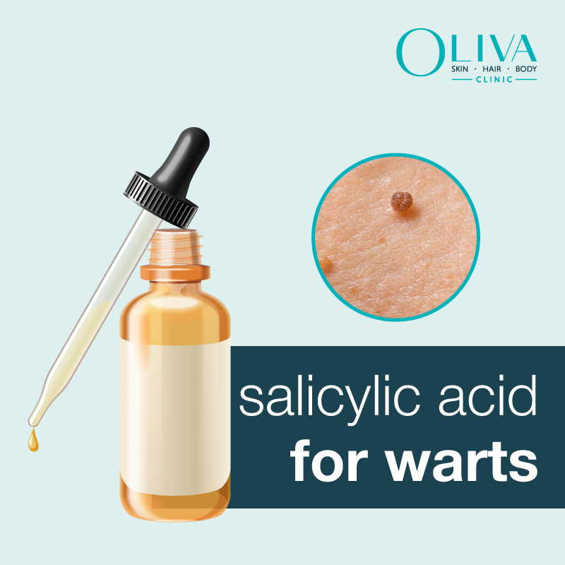 salicylic acid for warts