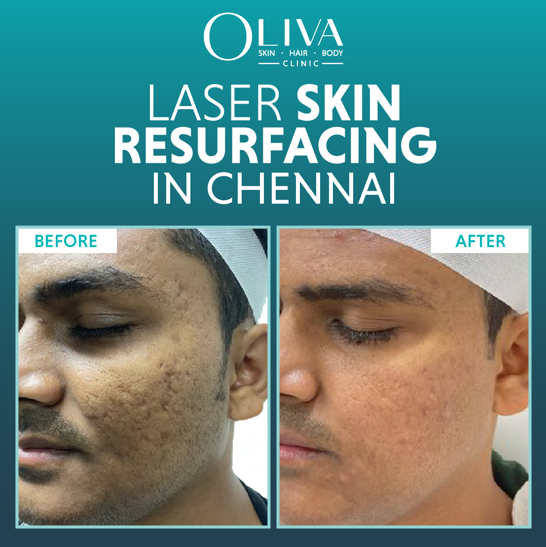 laser skin resurfacing in chennai