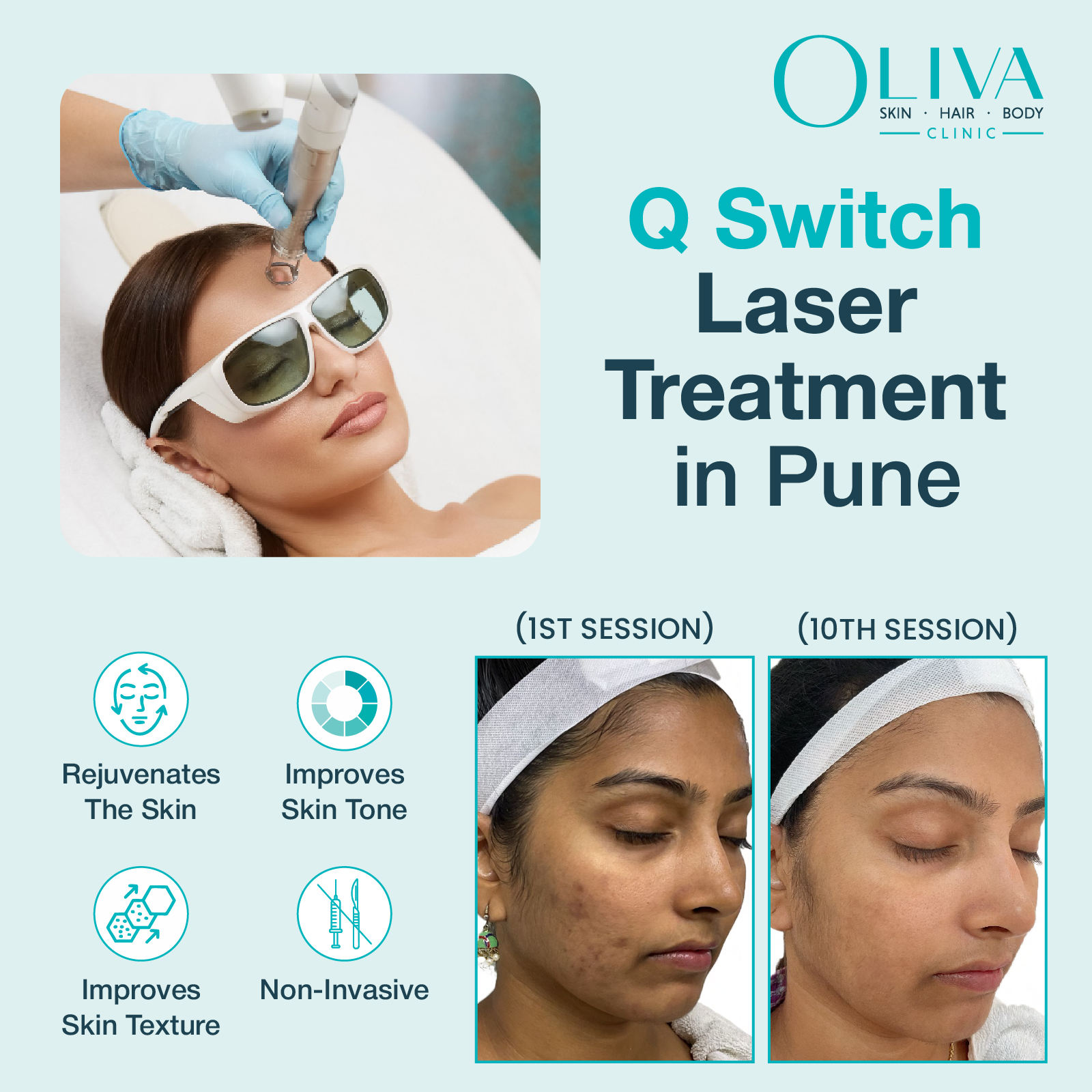 q switch laser treatment in pune