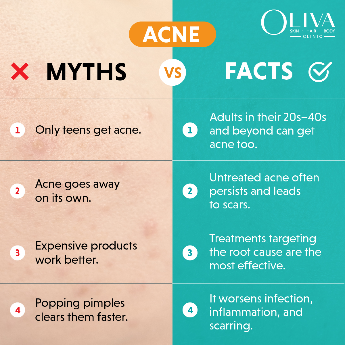 acne myths and facts