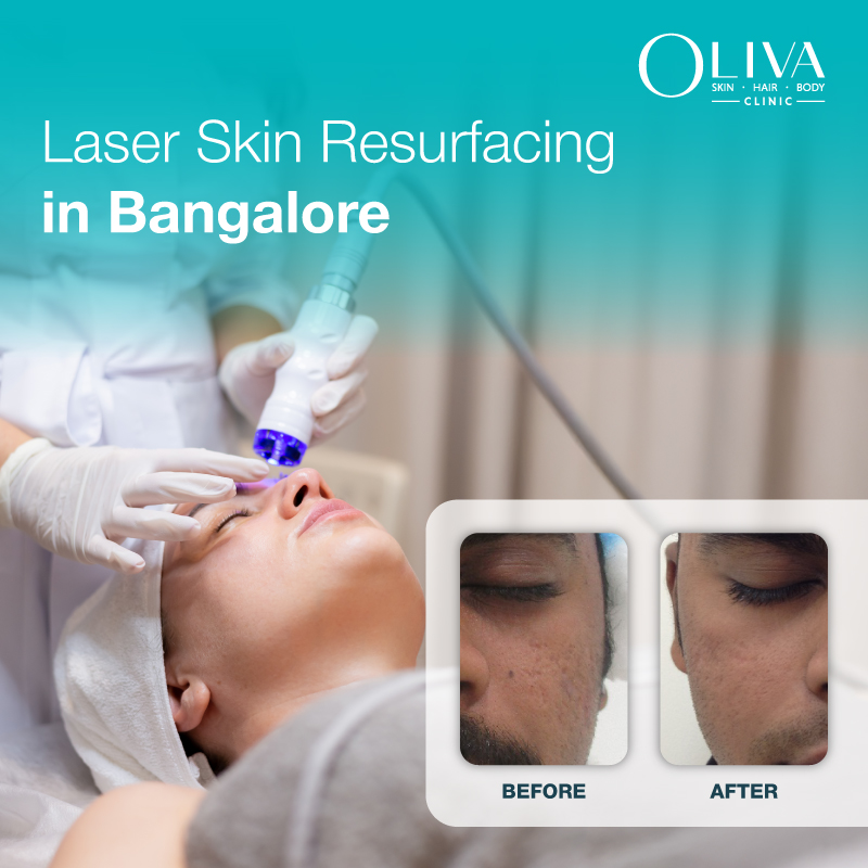 laser skin resurfacing in bangalore