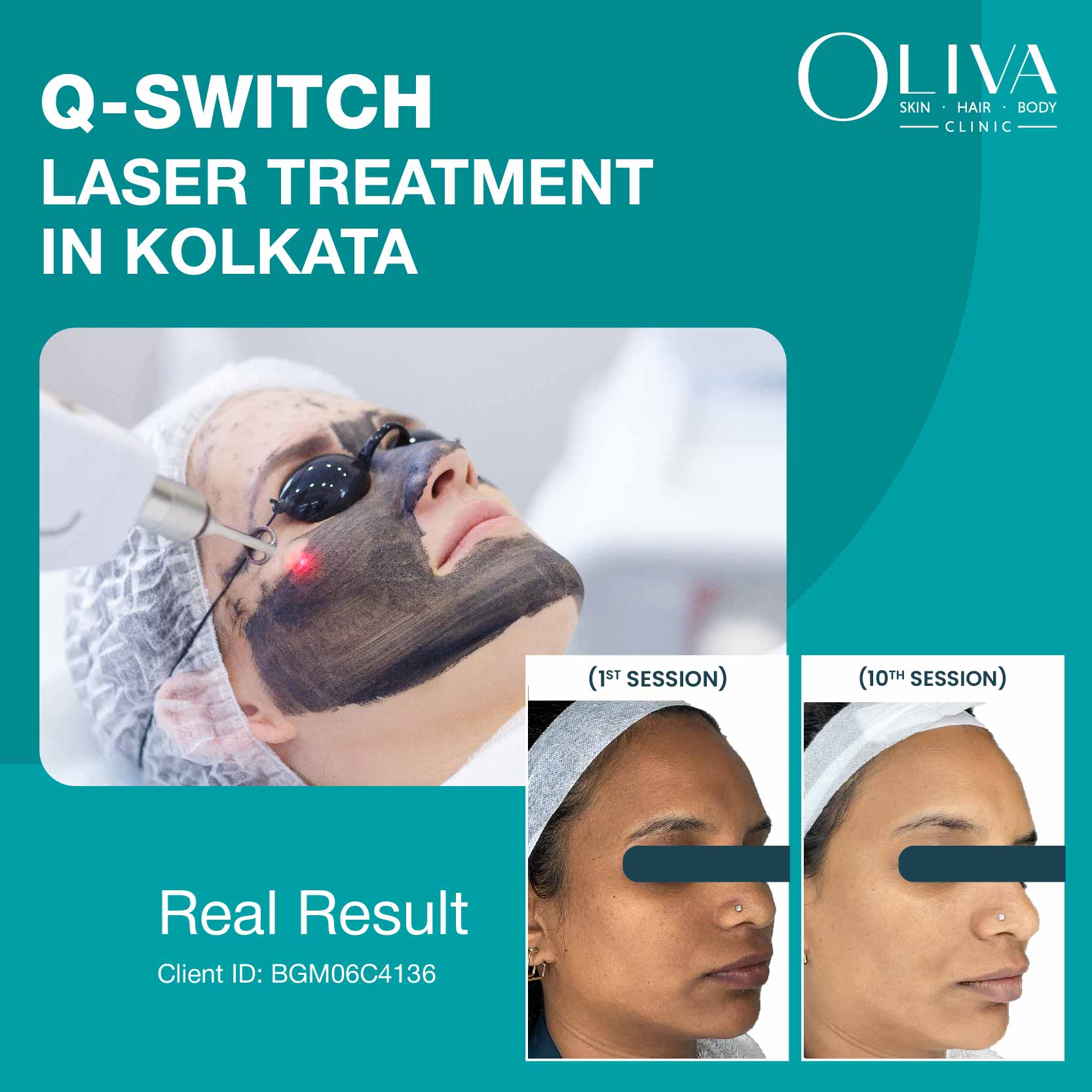 q switch laser treatment in kolkata