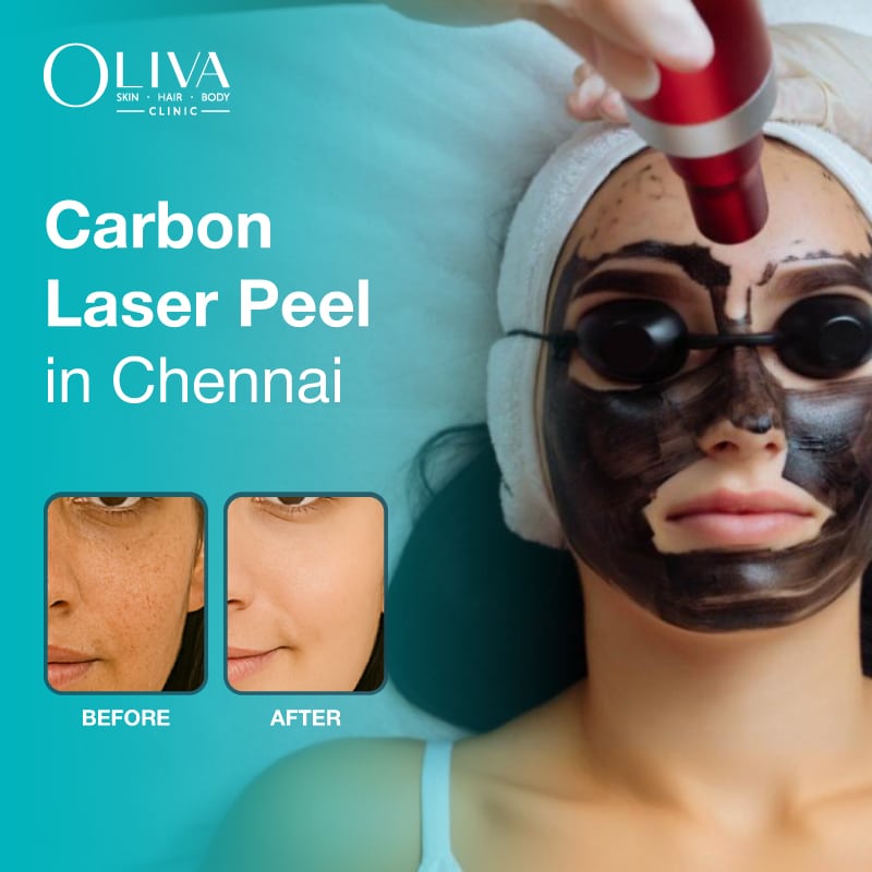 carbon laser treatment in chennai