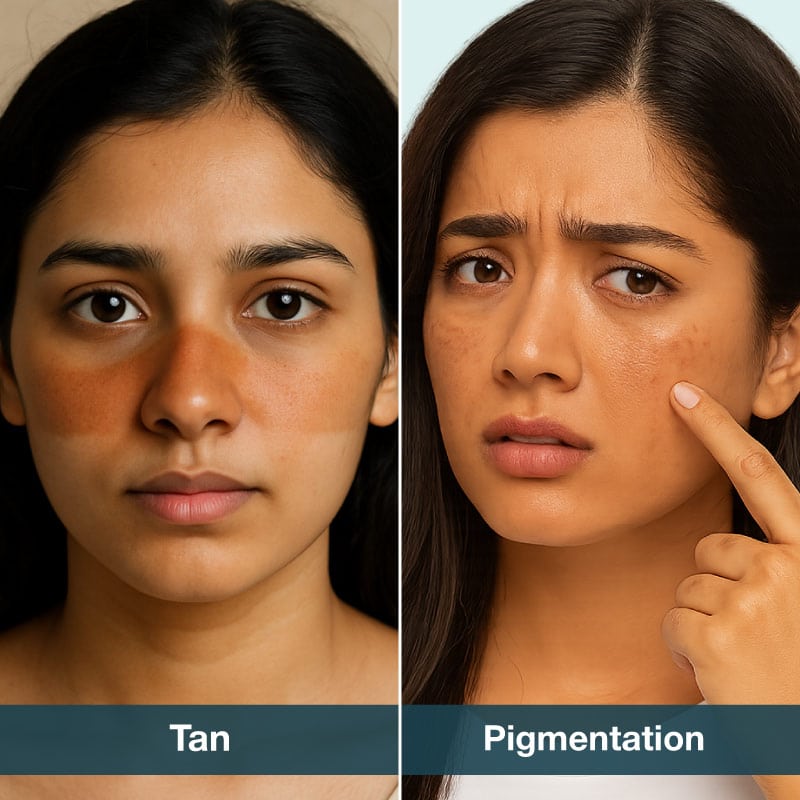 difference between tan and pigmentation