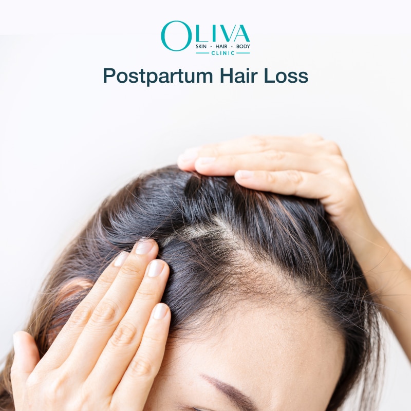 postpartum hair loss