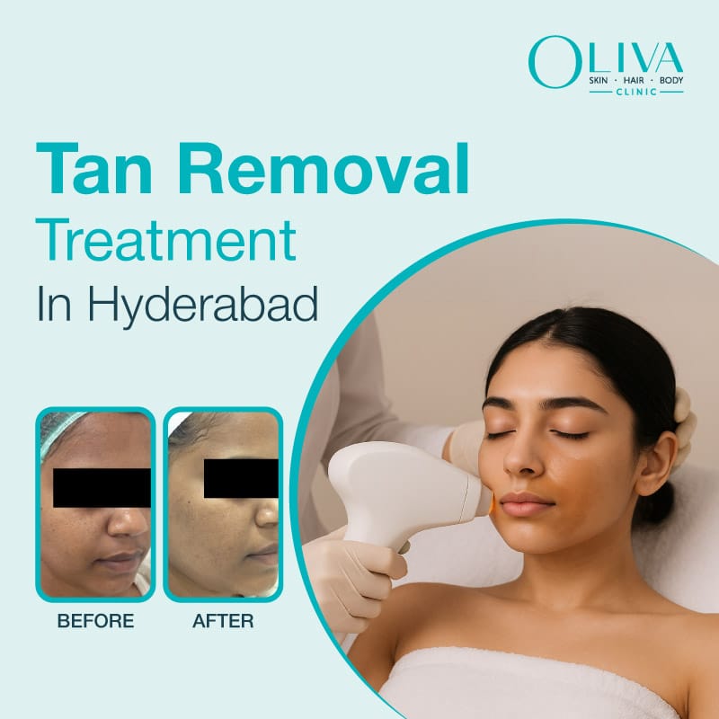 tan removal treatment in hyderabad