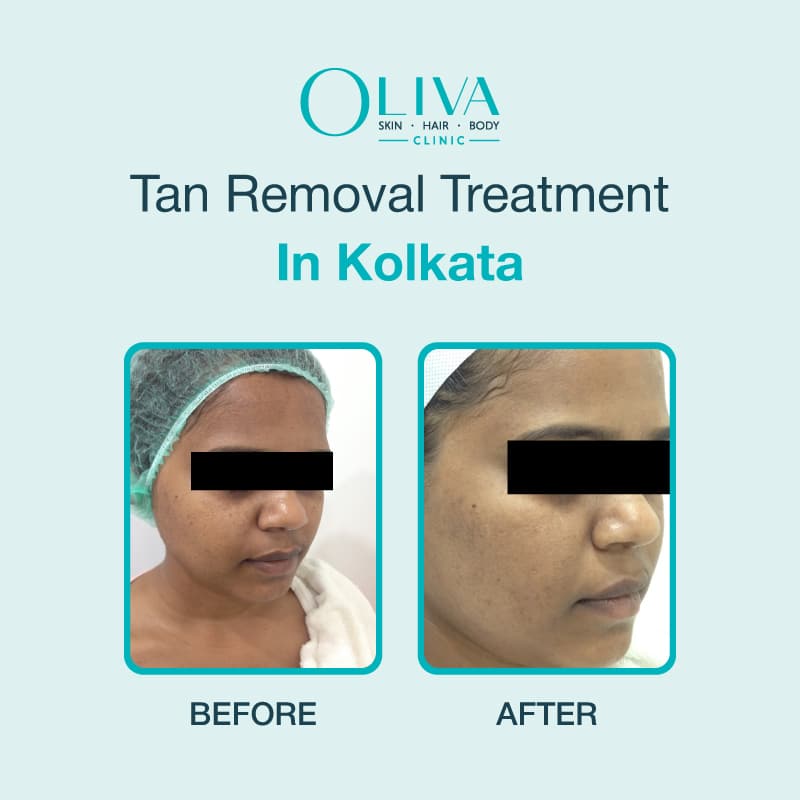 tan removal treatment in kolkata