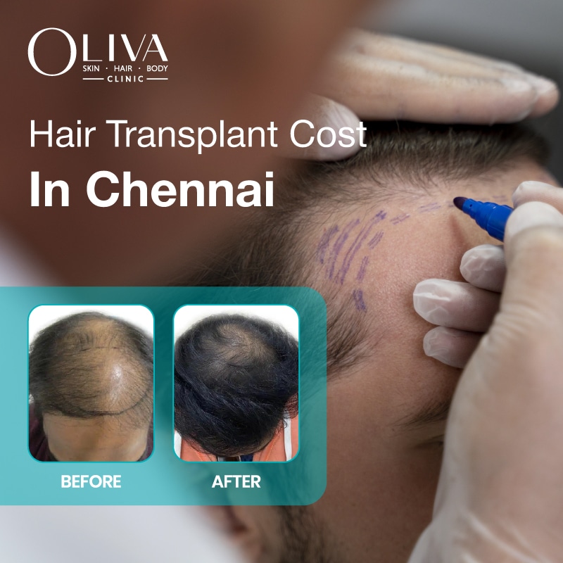 hair transplant cost in chennai