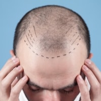 hair transplant
