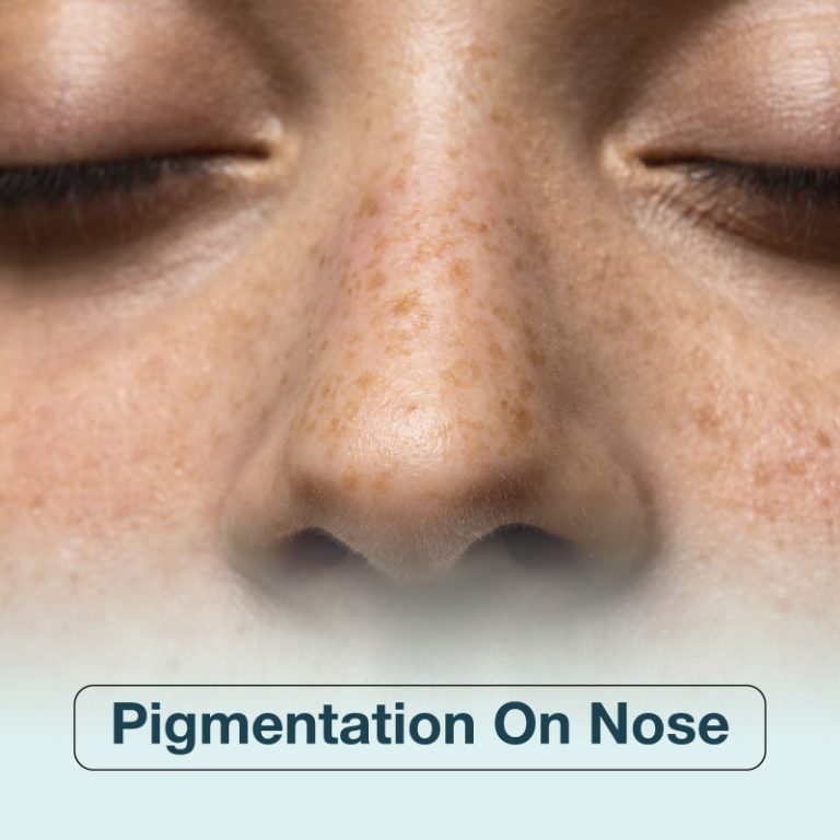 Heavy Pigmentation On Nose