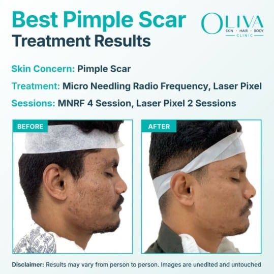 Pimple Scar Treatment