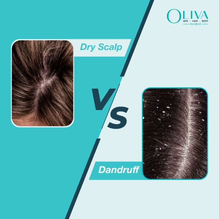 dandruff vs dry scalp