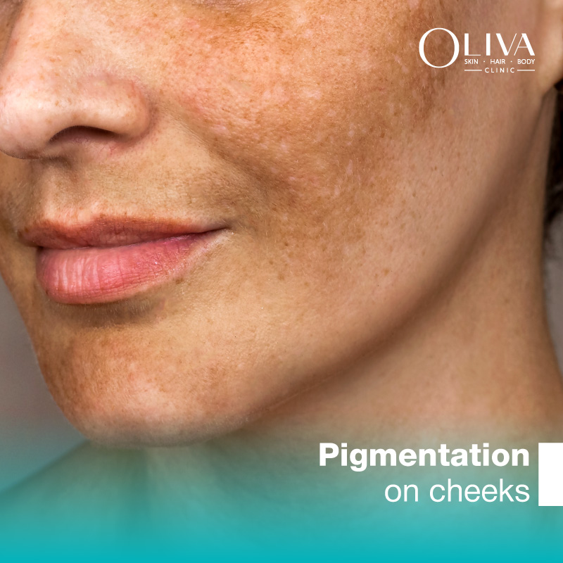 pigmentation on cheeks