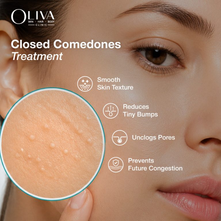 Closed Comedones Treatment